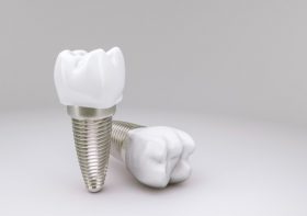 Esto es lo que no sabías sobre los implantes dentales